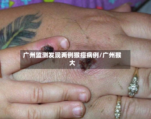 广州监测发现两例猴痘病例/广州猴大